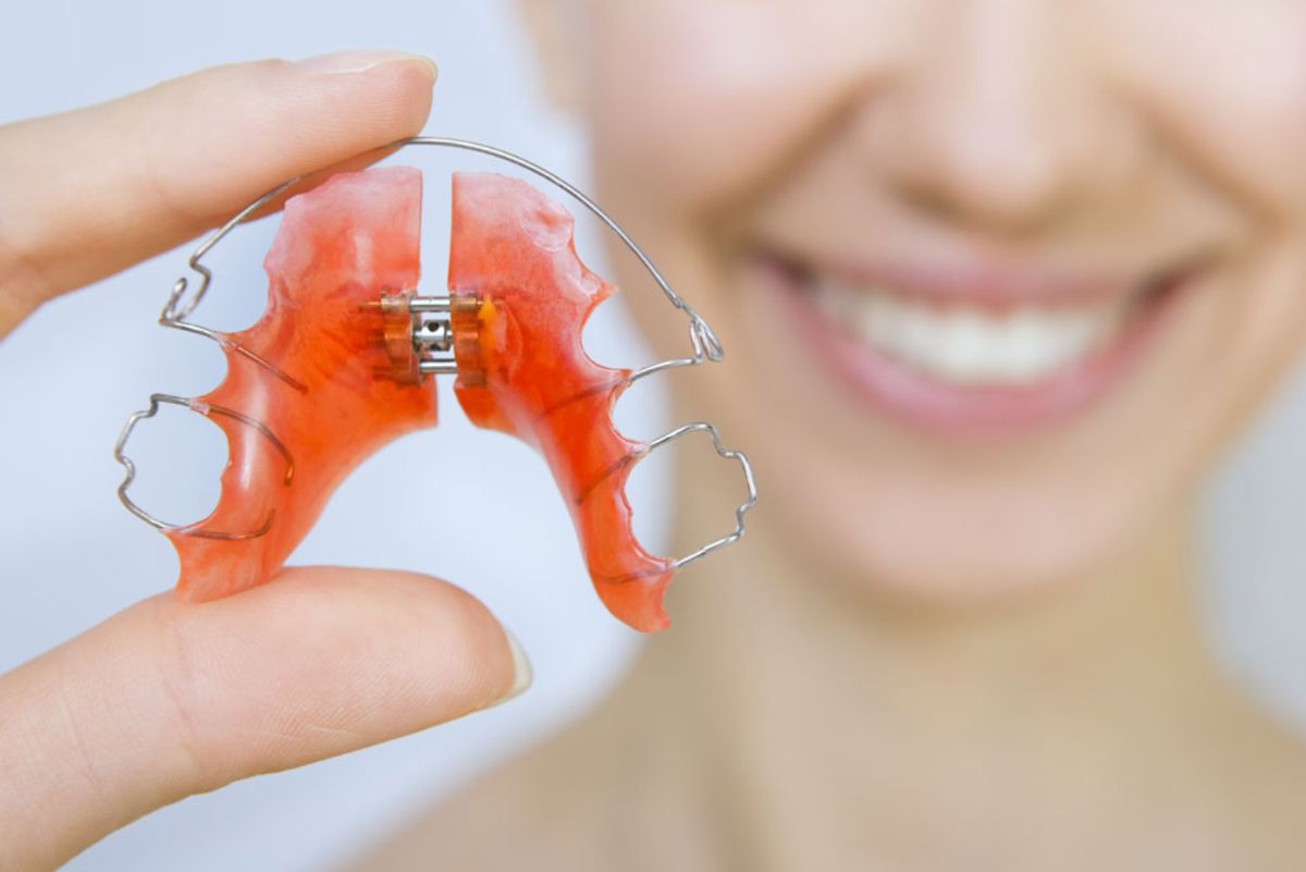 Everything You Need To Know About Retainers